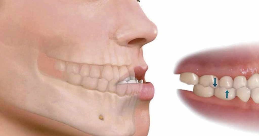 Different Types Of Malocclusions: Illustration of jaw with open bite and inset showing overbite arrows.