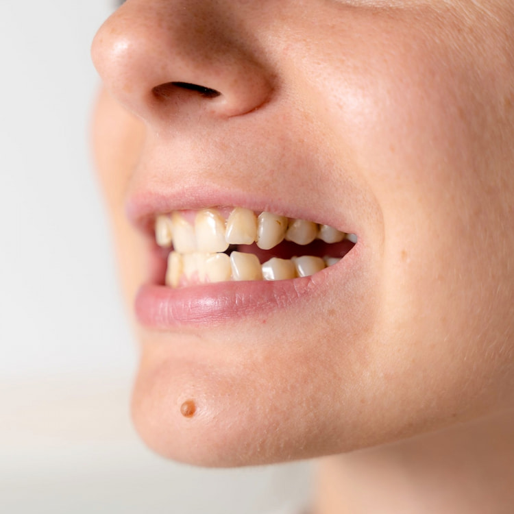 Close-up of mouth with discolored and misaligned teeth.