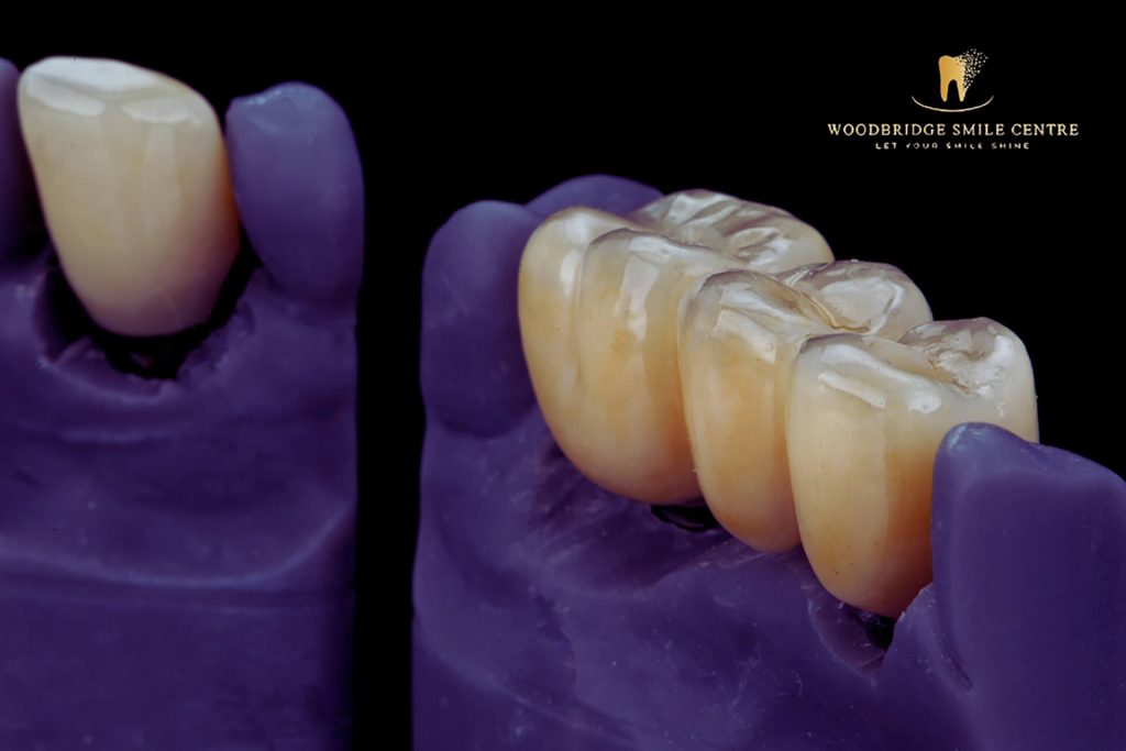 Dental Crowns Woodbridge