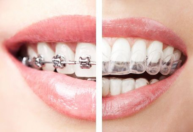 Invisalign vs. Braces: Which Option Is Best for You?