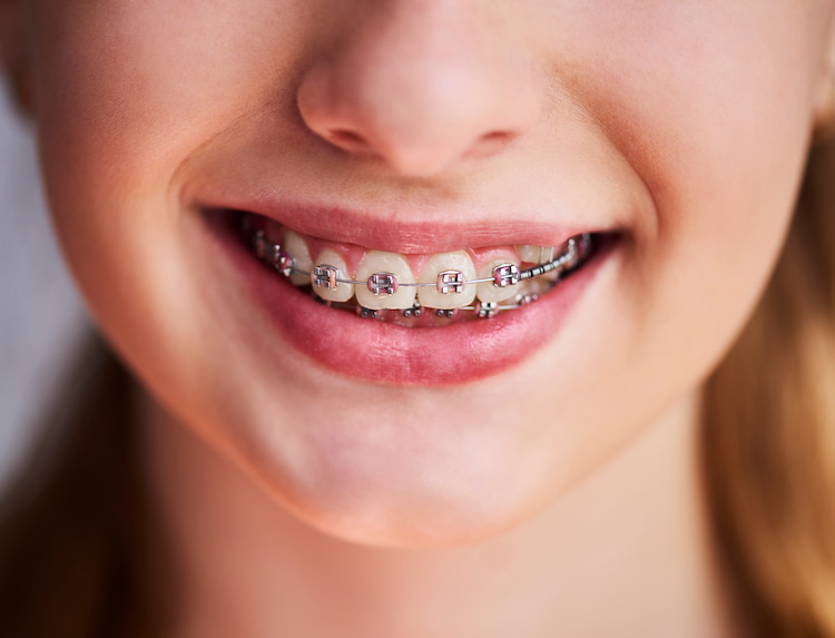 How Effective Are Traditional Braces?
