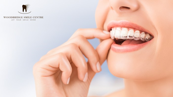 Close-up of the lower half of a woman’s face as she uses her fingers to fit an Invisalign aligner into her mouth