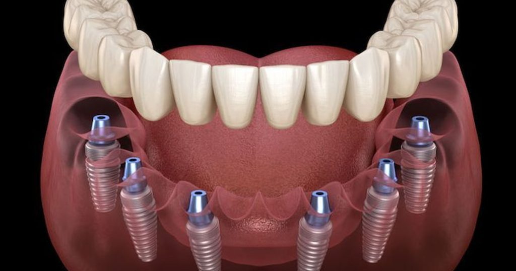 All on 4 Implants