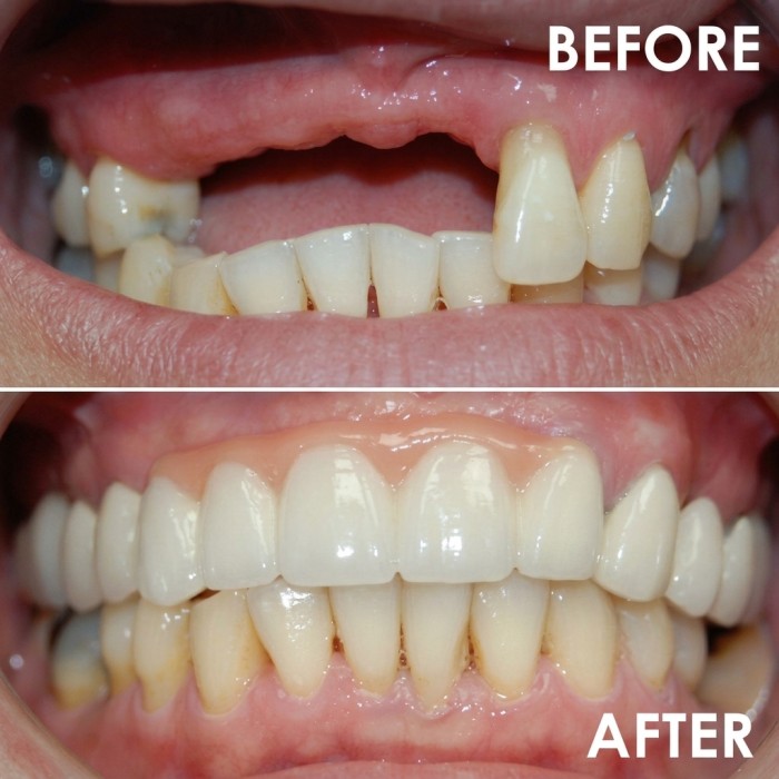 Before-and-after photos showing flexible partial dentures for upper teeth.
