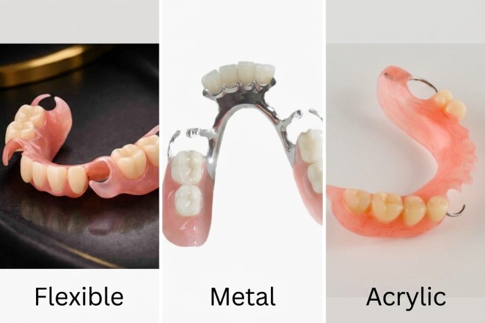 A side-by-side visual comparison of flexible, cast metal, and acrylic partial dentures.
