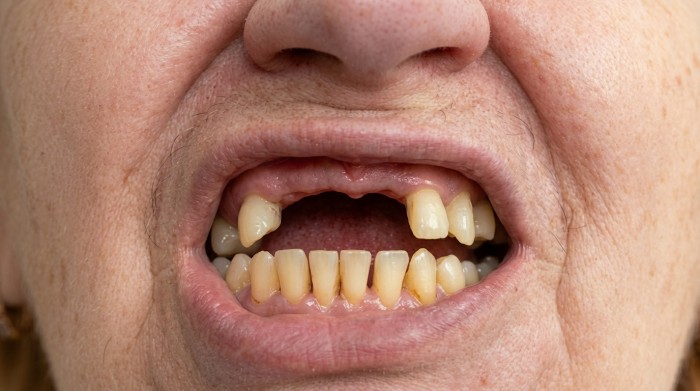 A close-up of an older adult’s upper front teeth with several missing teeth, potentially making them a candidate for flexible partial dentures.