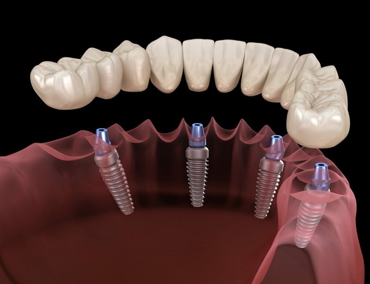 All-on-4 Dental Implants