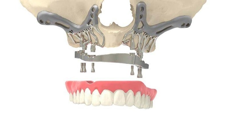 Subperiosteal Implants