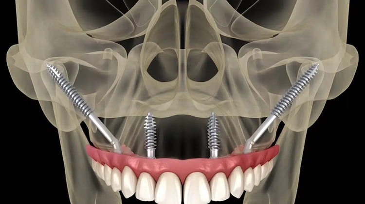 Zygomatic Implants