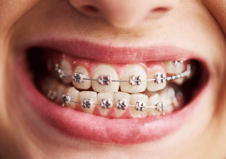 Traditional (metal) braces