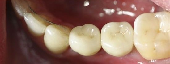 after dental implants by Dr. Aryan Rezaeifar