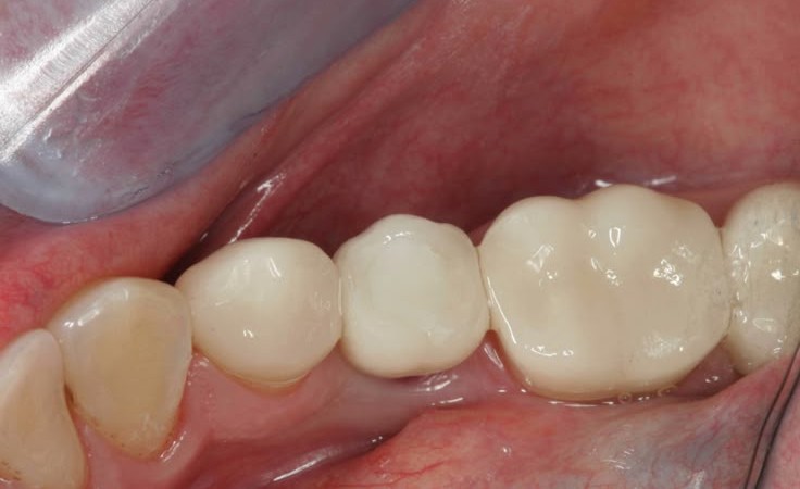 after dental implants by Dr. Aryan Rezaeifar