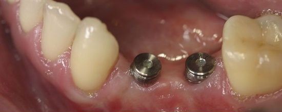 before dental implants by Dr. Aryan Rezaeifar