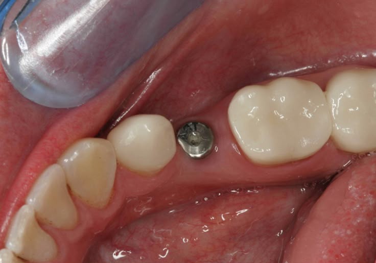before dental implants by Dr. Aryan Rezaeifar