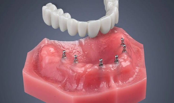 Mini dental implants