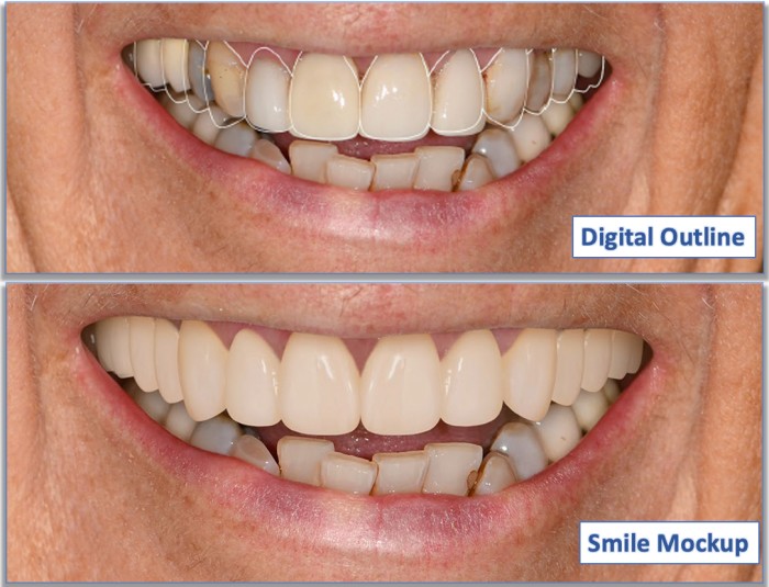 Close-up of a software-based dental layout and a Smile Mockup presentation.