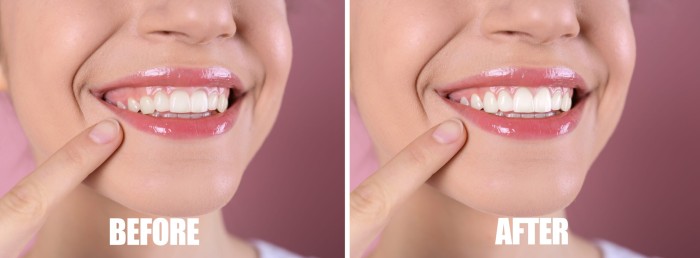 A Digital Smile Design simulation showing the expected outcome of gum contouring treatment.