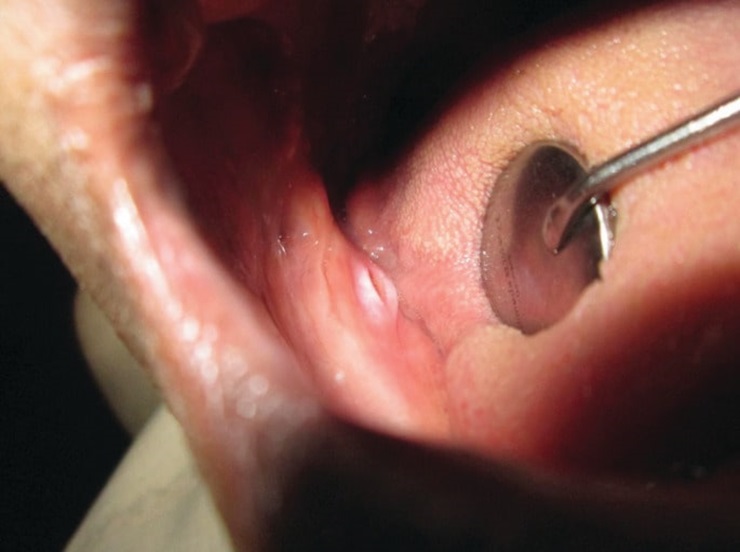 sores caused by dentures