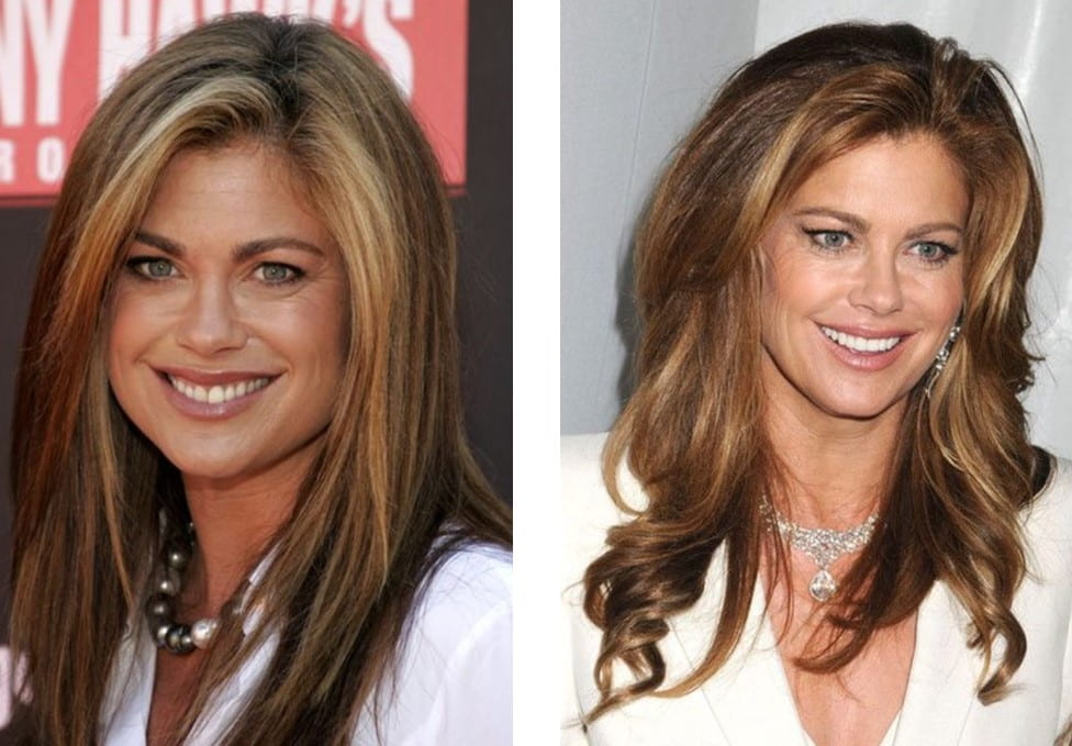 Kathy Ireland before and after implants
