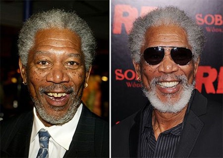 Morgan Freeman dental implants