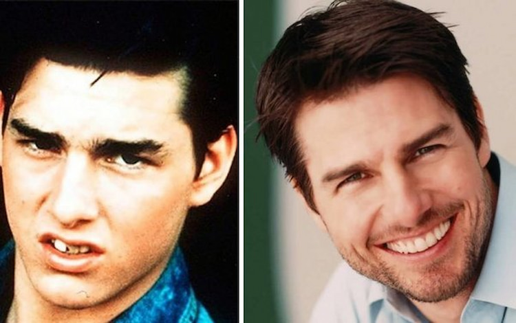 before and after of tom cruise's smile 