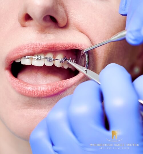 Broken Orthodontic Devices