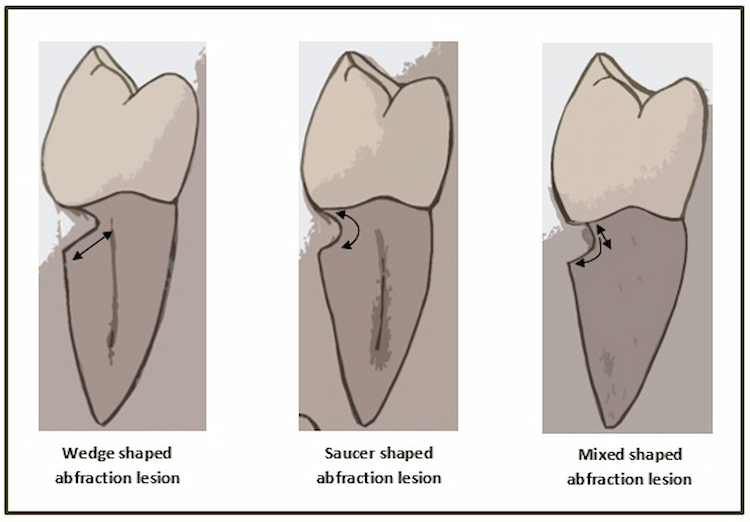 a photo showing three types of dental abfraction