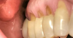 a photo of what dental abfraction looks like