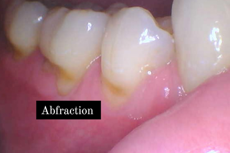a photo of Signs and Symptoms of Dental Abfraction