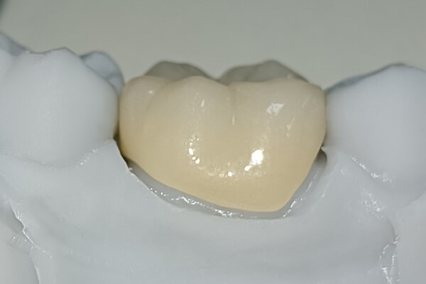 an image of a dental crown open margin
