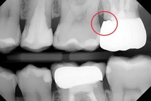 a photo of a realistic dental crown overhanging margin