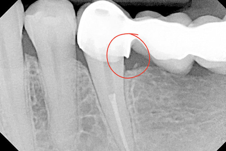 a photo of a dental crown overhanging margin 