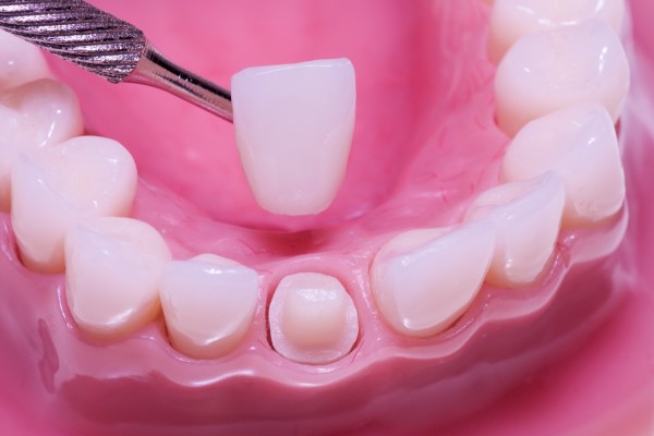 dental crown open margin treatments