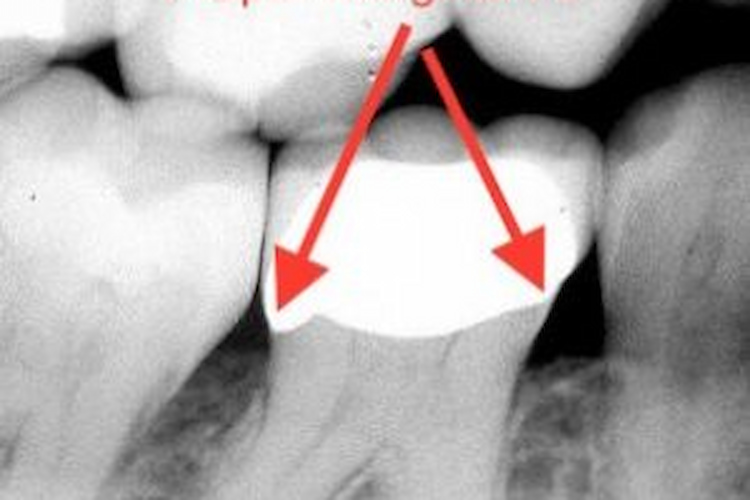 a photo of a proper dental crown hanging margin 