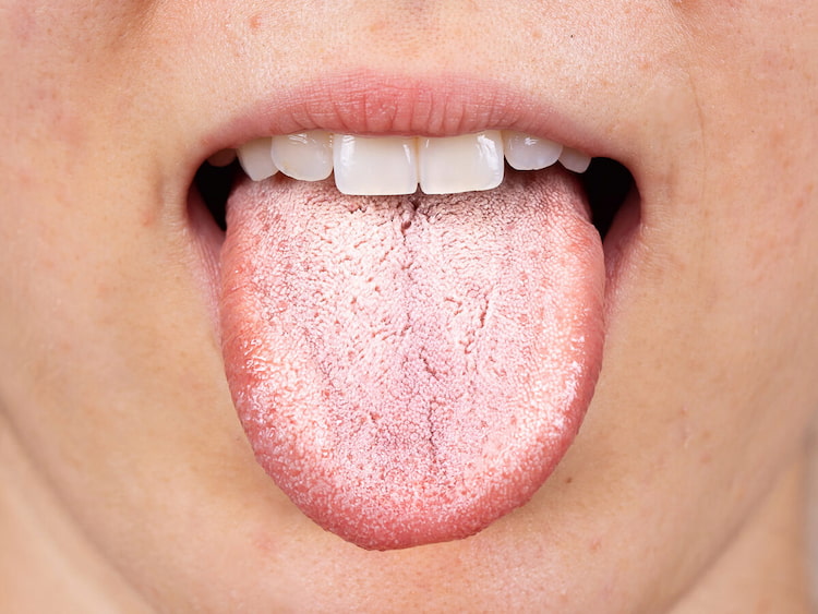 a photo of how dry mouth looks like