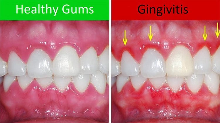 a photo showing the difference between healthy gums with swollen gums