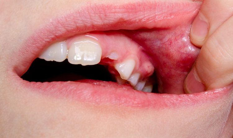 a photo of what swollen gums look like