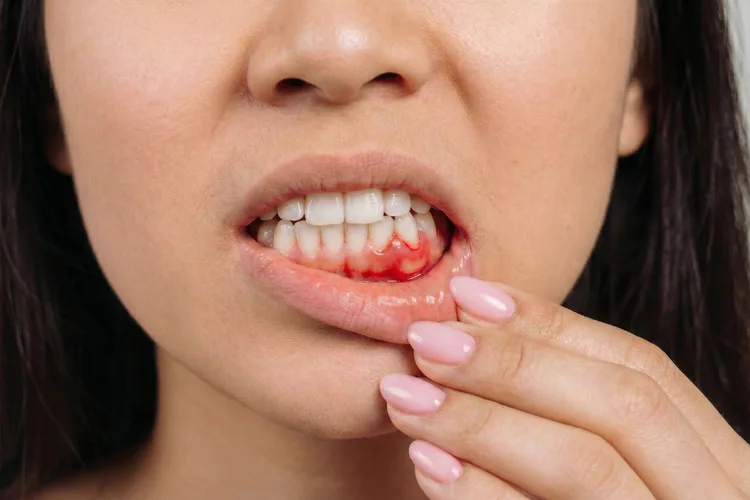 a photo showing swollen gums symptoms and signs