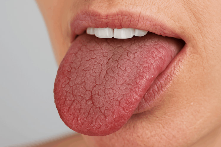 dry mouth with cracked tongue and lips