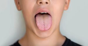 a photo of a person with chronic dry mouth