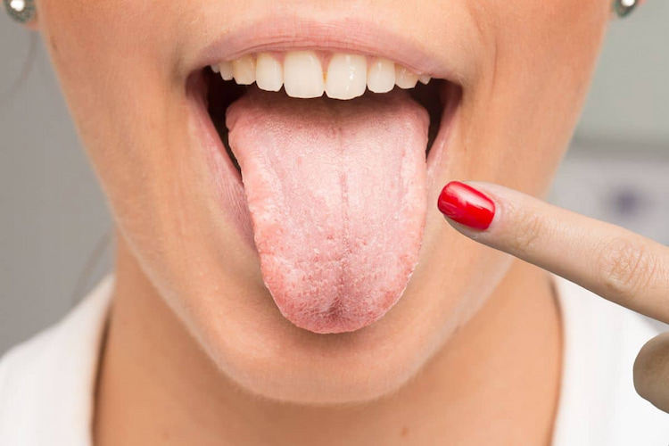 a lady showing dry mouth in the tongue