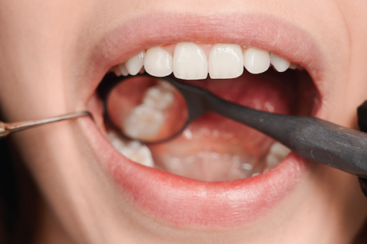 a photo showing how dentists perform cavity detection