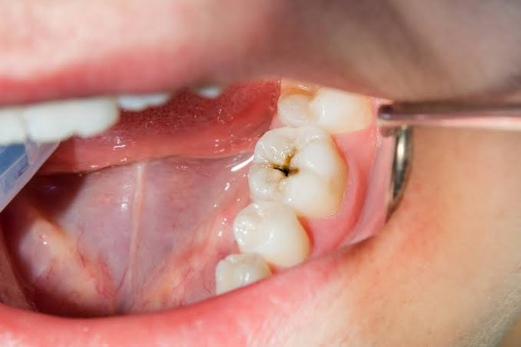 a photo of cavity detection