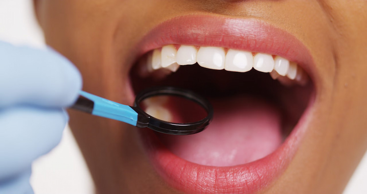 a photo of a dentist checking for craze lines in teeth