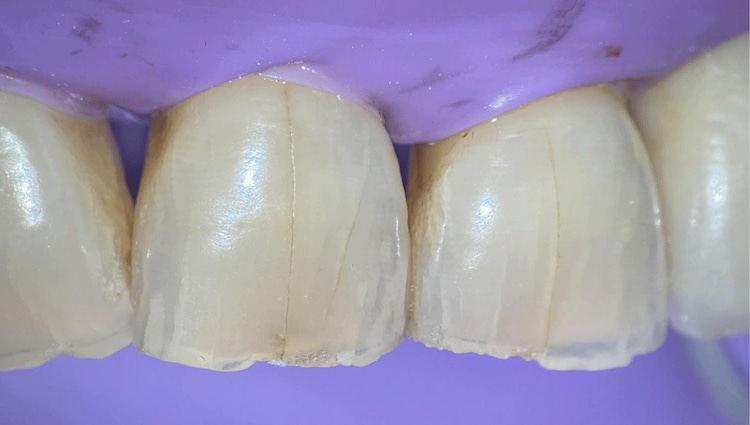 a photo of what craze lines look like
