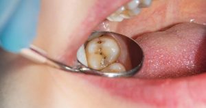 a photo of the process of early cavity detection