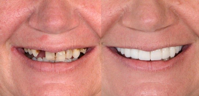 Close-up of a Digital Smile Design being used to plan a dental implant for a missing tooth and an overall whitening