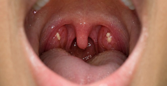 A close-up view inside the mouth clearly showing several tonsil stones