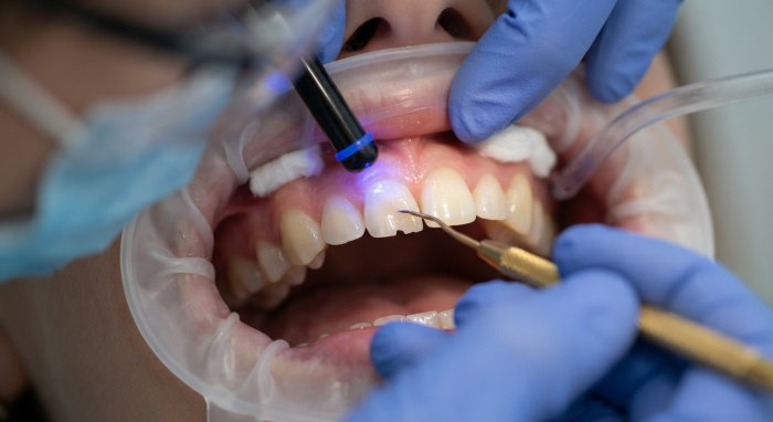 Close-up of dental bonding treatment being performed on a chipped tooth