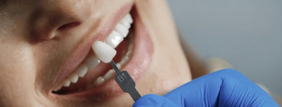 Dentist matching veneer shade guide to patient's teeth to fix crooked teeth with dental implants.